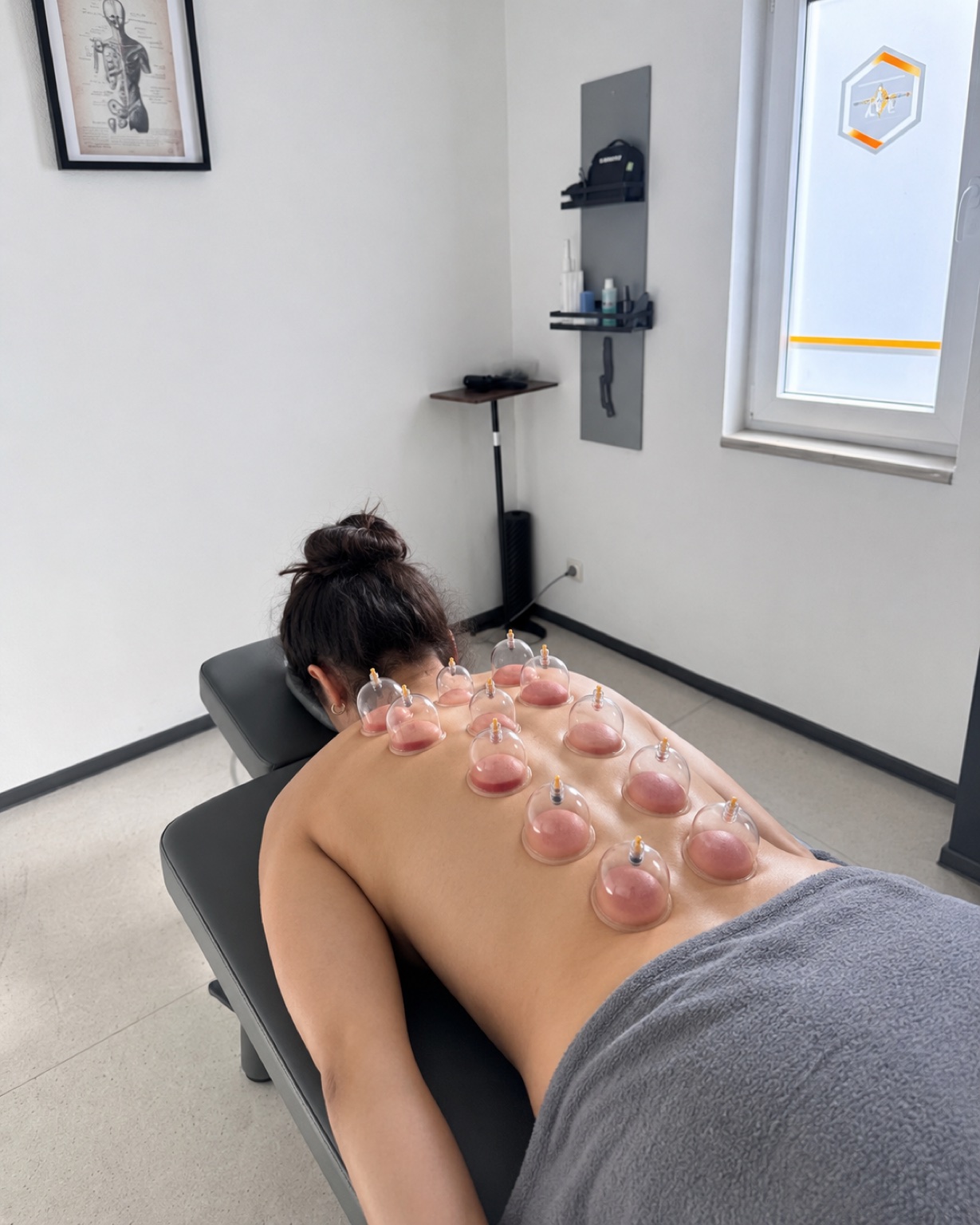 Schröpfgläser auf dem Rücken bei CF Physio